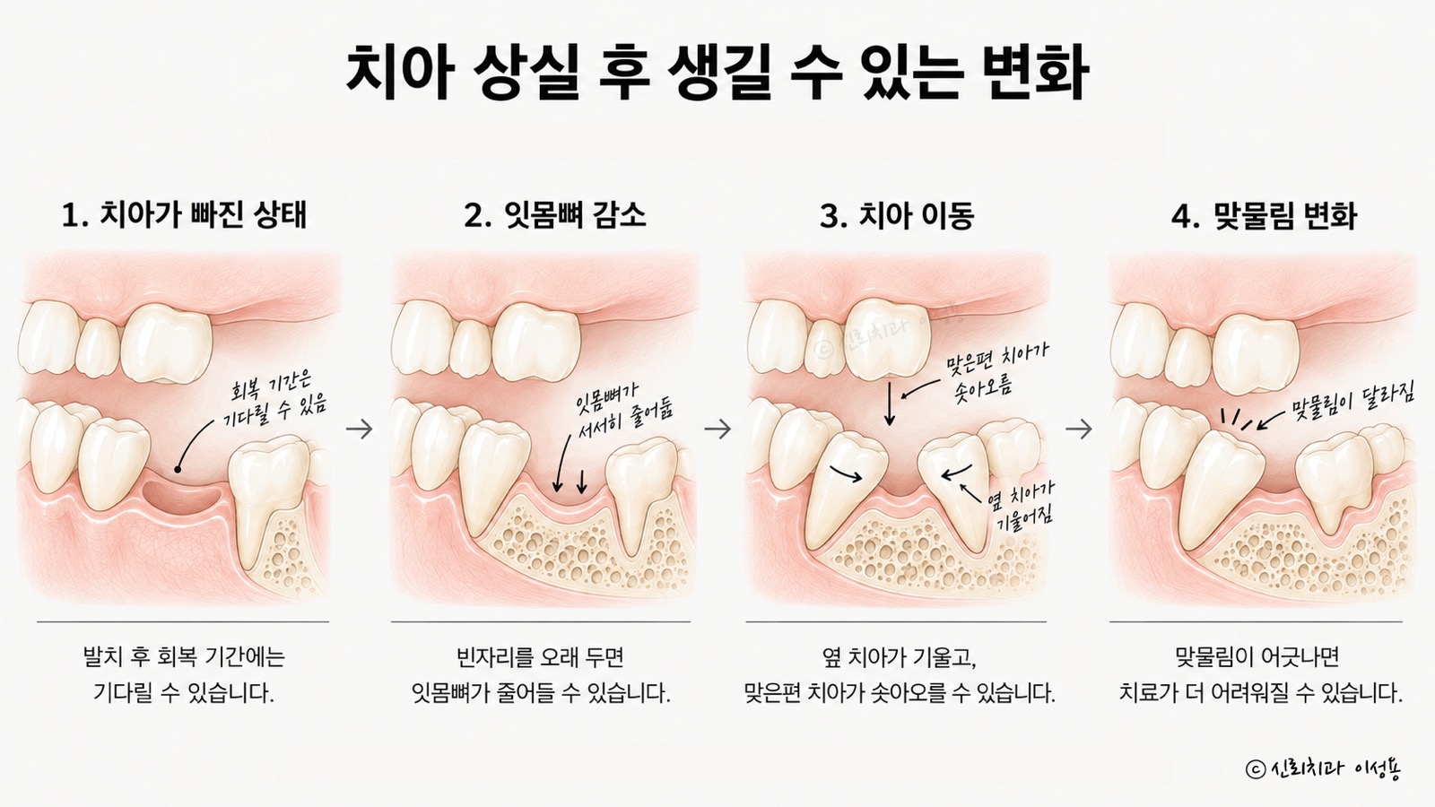치아가 빠진 상태에서 잇몸뼈가 줄고 옆 치아가 기울며 맞은편 치아가 솟아 맞물림이 달라지는 변화를 네 단계로 그린 그림