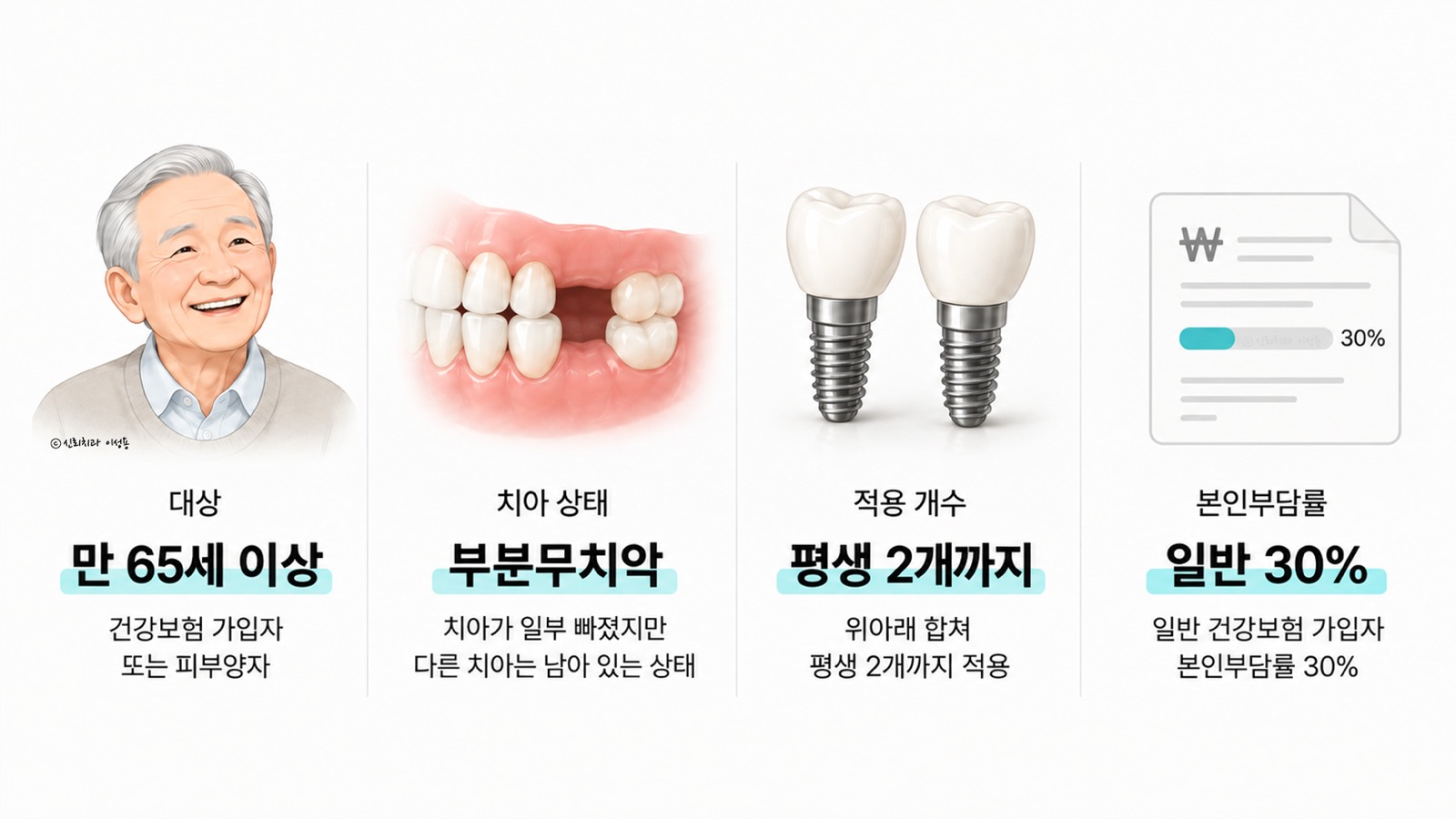 임플란트 건강보험 적용 조건을 네 칸으로 정리한 그림 — 만 65세 이상, 부분무치악, 평생 2개까지, 일반 본인부담률 30%